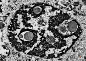 F,52y. | bone marrow - inclusions in plasmocytes F,52y. | bone marrow - inclusions in plasmocytes